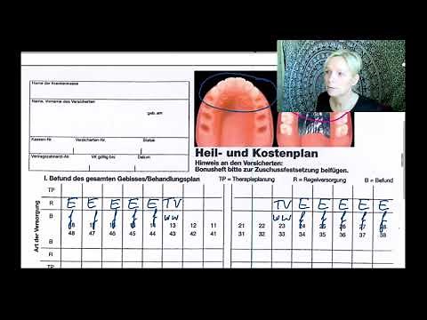 Modellgussprothese mit Teleskopkronen