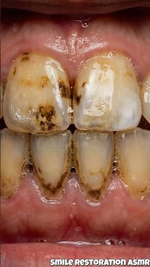 UNBELIEVABLE 😱 Severely Stained Teeth Turn Pure White | Extreme Whitening Transformation #satisfying
