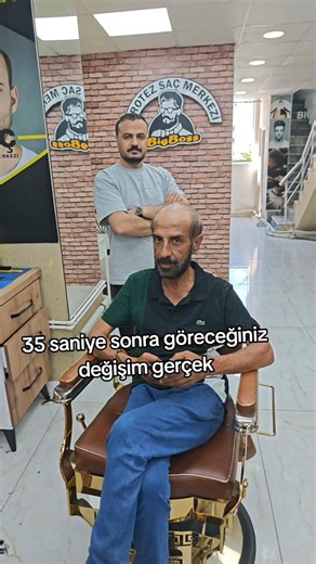 dünyanın her yerine kargo ile gönderim yapıyoruz #protezsaç #ytdayibenionecikarnolur #değişim