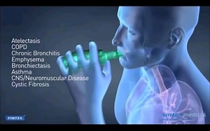 Acapella 排痰器 (mucus clearance device)