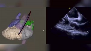 Single ventricle with Blalock-Thomas -Taussig shunt in a 57 year old lady with recurrent AF refractory to all meds | Cardiophilia | Facebook