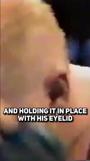 This Wrestler’s Eye Came Out Of It's Socket During A Match