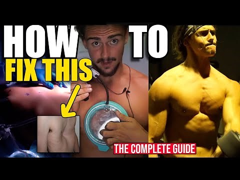 The Complete Guide to Fixing Pectus Excavatum Sunken Chest Deformity