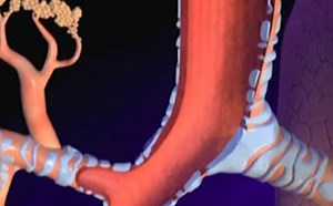 Medical Animation: Cystic Fibrosis