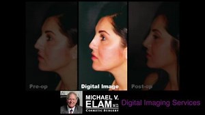 Nose Job Results and the Importance of Digital Imaging — The Doctor Explains This Woman's Before & After