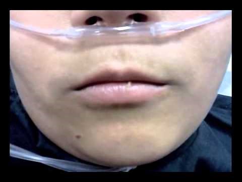 Perioral Myokymia