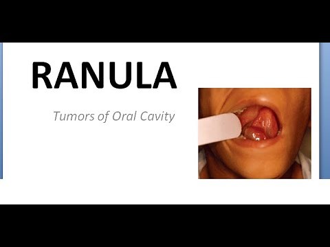 ENT Ranula Tumors of oral cavity Below tongue swelling mass round cyst plunging sublingual salivary