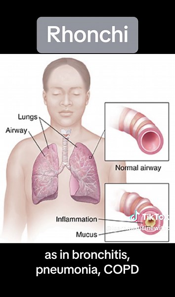 Auscultation of abnormal breath sounds review: Wheeze, Rhonchi, Rales/Crackles #physicianassistant #physicianassociate #pastudent #paschool #physicianassistantlife #palife #physicianassistantstudent #physicianassistantschool #prepa #medicine #medicineexplained #medtok #medschool #medstudent #medicalschool #medicalstudent #nursingstudent #nursingschool #healthcare #healthcareworker #wheeze #rhonchi #rales #pulmonary #lungs