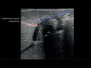 Ultrasound-guided UVC 2_Umbilical Venous Catheter Malposition (Kozyak et al)
