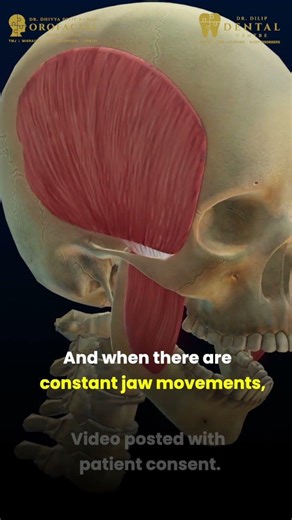 When Fascia Tightens,It Triggers Headaches PART 1