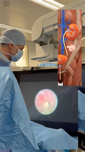 Kidney stone removed LIVE: Laser vs. stone – this is how the surgery works!