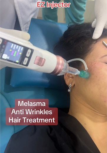 Melasma and Anti-Wrinkle Treatments with EZ Injector