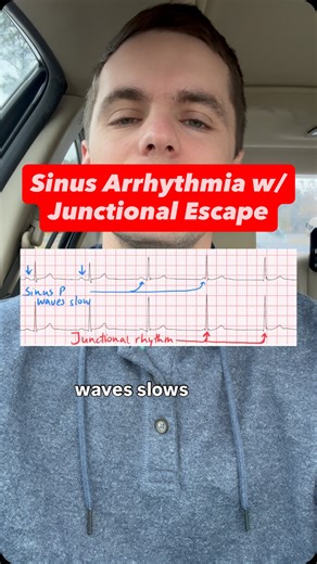 ECG Lectures with Reid on Instagram: "Understanding Sinus Arrhythmia with Junctional Escape findings on ECG"