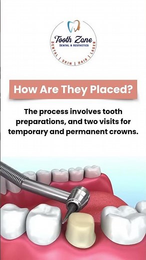 Dental Crowns -Types, Price & Comparison | Cost of Zirconia Cap | the best cap for teeth?