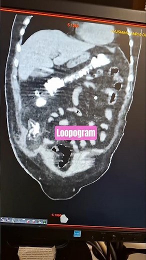 Distal Loopogram CT scan #shortsfeed #viral #hospital #shorts #short #shortsvideo