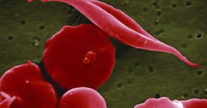 FDA approves 2 gene therapies for sickle cell. One is the first to use the editing tool CRISPR