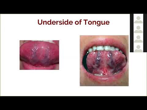Art of Ayurveda Tongue Diagnosis 6 of 9: Under the Tongue / Sublingual Veins