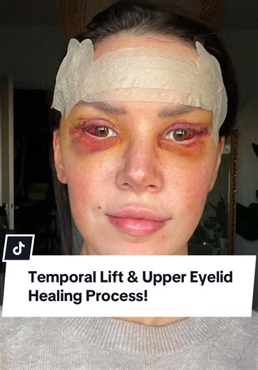 Upper Eyelid Healing Process: Before and After