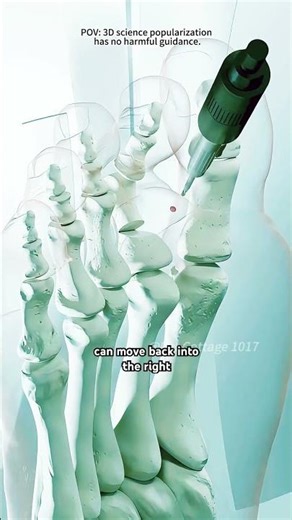 How Hammer Toe Surgery Is Performed? (3D Animation)