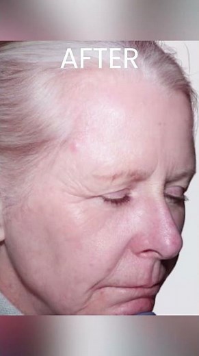 Skin Transformation: Before and After Laser Treatment for Redness
