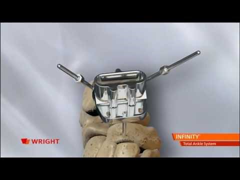 Wright Medical Infinity Total Ankle Implant