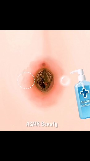 ASMR Satisfying Belly Button Navel Stone Piercing Removal Treatment Animation | ASMR Beauty #fbreels #facebookreels #Viralシ #fypシ #skincare #earwaxremoval #asmrsounds #reels #beauty #trending #asmr #animation #viral #makeup #belly #asmrbeauty | ASMR Beauty