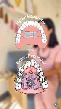 Hyrax vs. Evans expander explained. #RPE #hyrax #mariannaevans