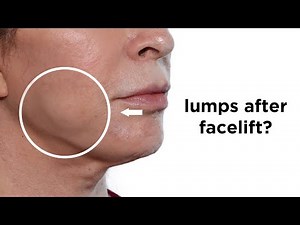 Bulges and bumps after facelift explained | Can facelift make buccal fat pads more noticeable?