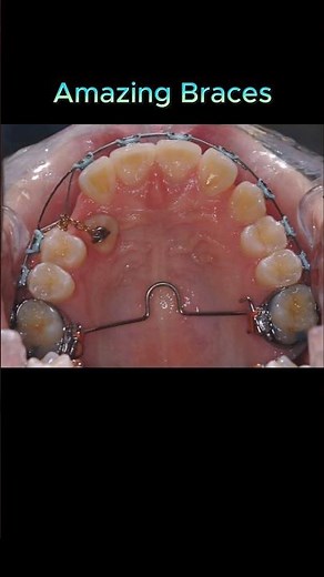 amazing braces: pull out impacted tooth to correct position #braces #orthodontist #dentist