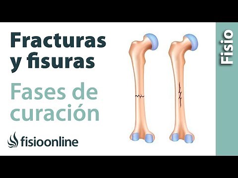¿Qué es una fractura y una fisura y cuáles son sus fases de curación?