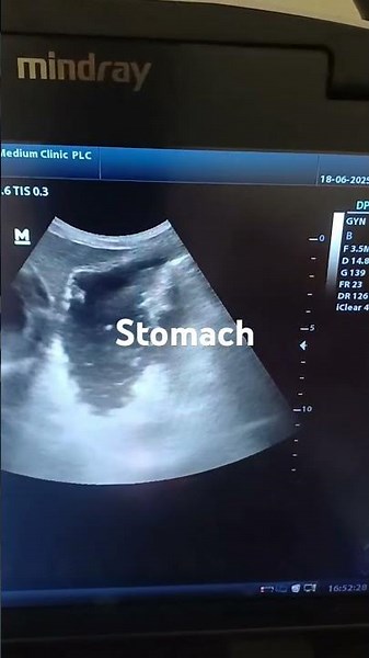 stomach scan