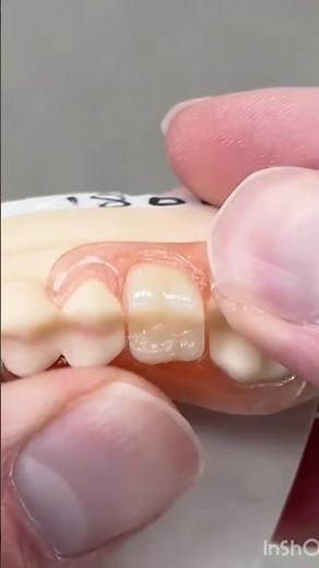 “What Is A Removable Partial Denture?”