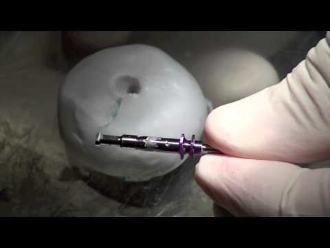 Custom Impression Copings - NobelActive Dental Implant