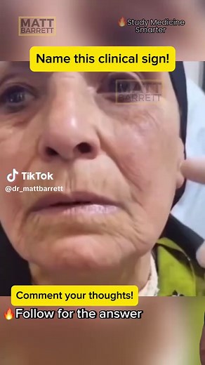 Chvostek's Sign Explained for Medical Exams