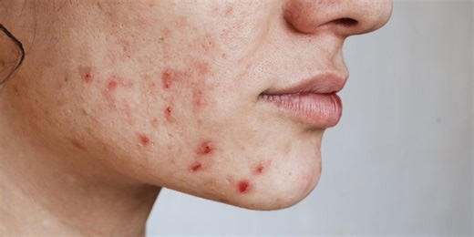 A virus can 'cure' acne without making you ill and it's coming to skincare