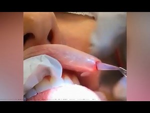 Bot Fly or Lip Implant - Bizarre Removal from Lip