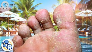 19K views · 113 reactions | Ahhh summer--the season of ringworm. Fun fact (playing fast and loose here with the term fun)--ringworm is not actually a worm. It's a fungus. And here's how to avoid it and how to get rid of it if you happen to contract ringworm. | Reactions | Facebook