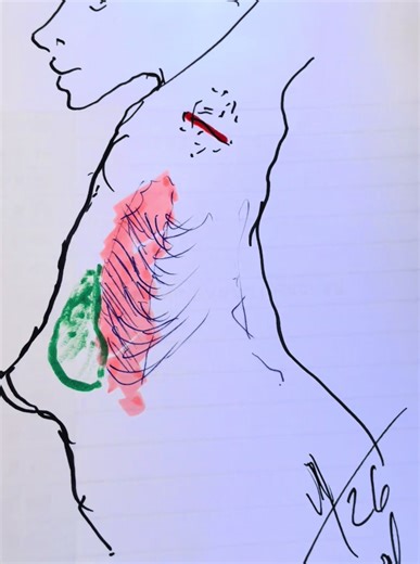 Réaliser une augmentation mammaire par voie axillaire, elle ma méthode favorite par son voie, pratiquement jamais la cicatrice résiduelle. Les prothèses en position pré musculaires, pectorales, évite d’avoir les seins qui remontent quand on est à la gymnastique.. enfin les prothèses de l’époque, 2000 2010 dur bien plus longtemps que prévu puisqu’on arrive en moyenne à 20 ou 25 ans de stabilité, sans avoir besoin de les changer sauf rupture exceptionnelle#Docmitz8 #augmentation mammaire#prothèse,