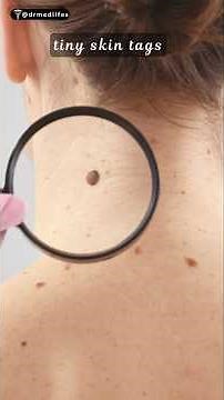 Skin tags |what's really causing skin tags | skin tags causes #skintags #skin #skincare #dermatology