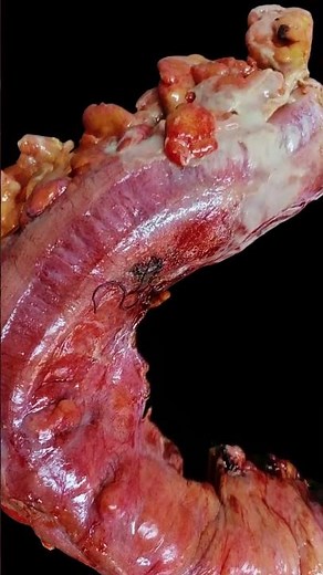 Colic resection (sigmoidectomy): What's the diagnosis?