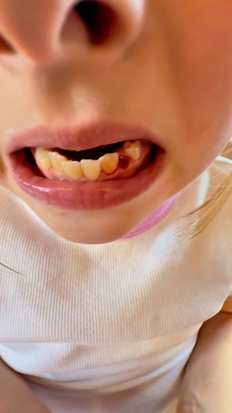 Leo lost his tooth 🦷 #siblings #funny #familychaos #humor #comedy