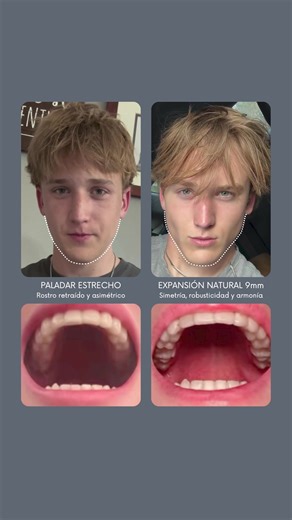 250K views · 8.1K reactions | 3 ejercicios para cambiar tu mandíbula, primera parte. Y para más contenido similar, no dudes seguirnos, que contamos con múltiples entrenamientos gratuitos de valor ya publicados. . Autor: @esculpetudesarrollo . . #mewing #mandibula #rostro #salud #belleza #funcional #fitness #dentista #dientes #short | Esculpetudesarrollo | Facebook