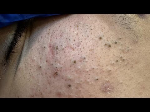 ASMR Pimple Popping and Blackhead Removal | Deep Facial Cleansing Techniques
