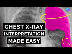 Chest X-ray Interpretation | How to Read a CXR | OSCE Guide | UKMLA | CPSA | PLAB 2