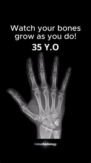 At birth, the hand is mostly cartilage—soft, flexible, and perfectly designed for a new human entering the world. Early X-rays look almost empty, showing only a few bright spots where future bones will emerge. The hand at this stage is more possibility than structure. During childhood, ossification centers begin to appear like tiny points of light. These areas gradually harden into the bones we recognize, while strength and coordination steadily develop. Even then, much of the hand remains unfin