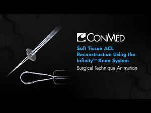 Soft Tissue ACL Reconstruction Using the Infinity™ Knee System - CONMED Animation