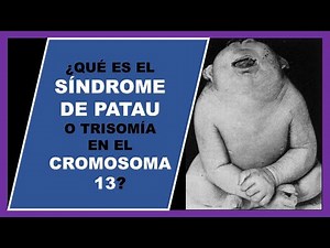 Patau syndrome | Trisomy 13