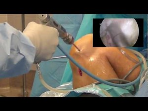 Arthroscopic ACL Reconstruction  • Video • MEDtube.net