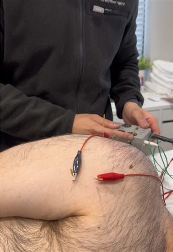 Here's how dry needling can help your shoulder pain: Dry needling stimulates cellular activity around the site of injury and improves the healing process in your extensor tendons. Dry needling RELIEVES PAIN! Despite the initial soreness, dry needling releases chemical mediators that reduce pain in your elbow. For more information please CALL or TEXT (905) 257-4333 BOOK NOW! www.physiopros.ca ✅ Flexible hours ✅ Direct billing available ✅ Book online or by phone #manualtherapy #physiotherapy #shou