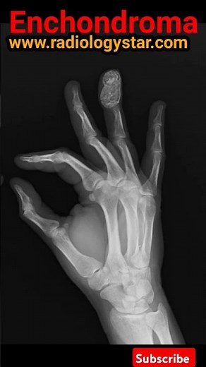 Hand X-ray View | Enchondroma #handxray #enchondroma #xray #shorts #radiology